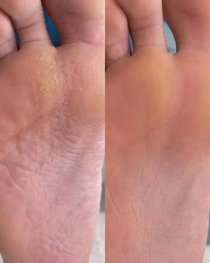 Creme tratamento com efeito antibacteriano NATI Callux.Pro®